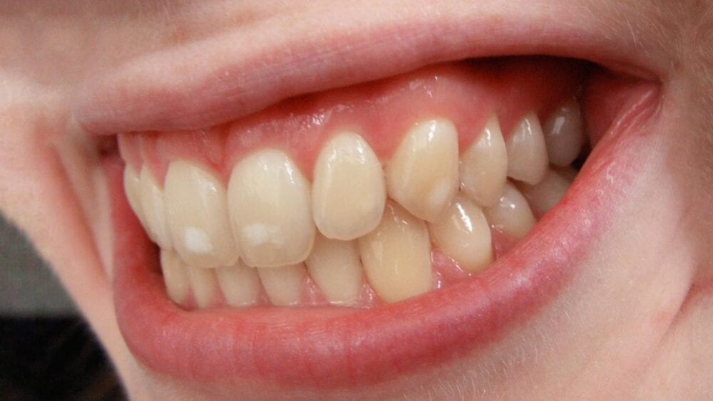 Dental Fluorosis