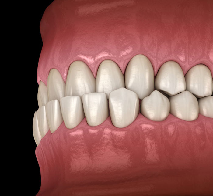 Underbite
