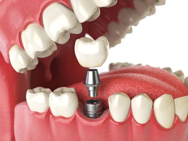 After Dental Implant