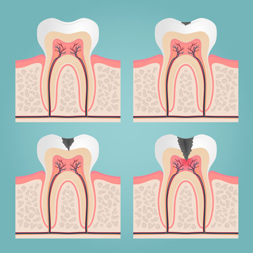 Dental Filling