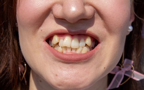 teeth grinding