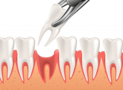 permanent teeth