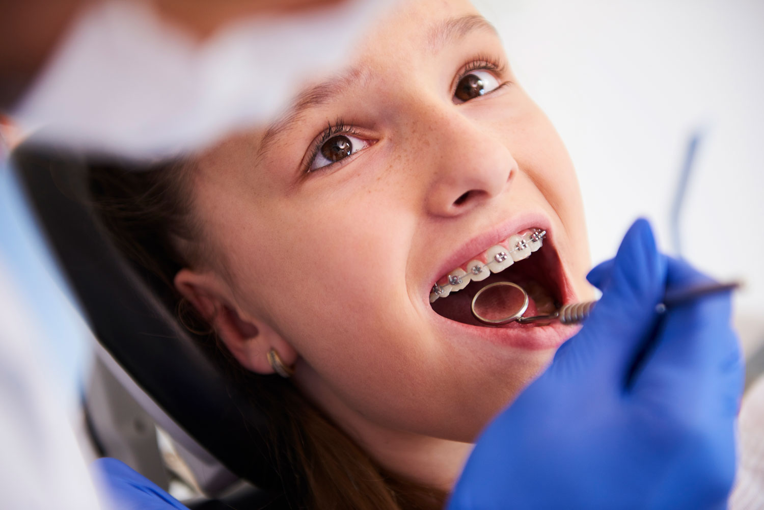 types of braces