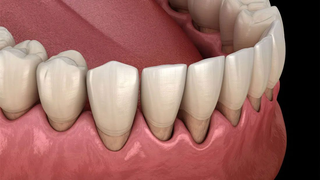 Treatment of Gingival