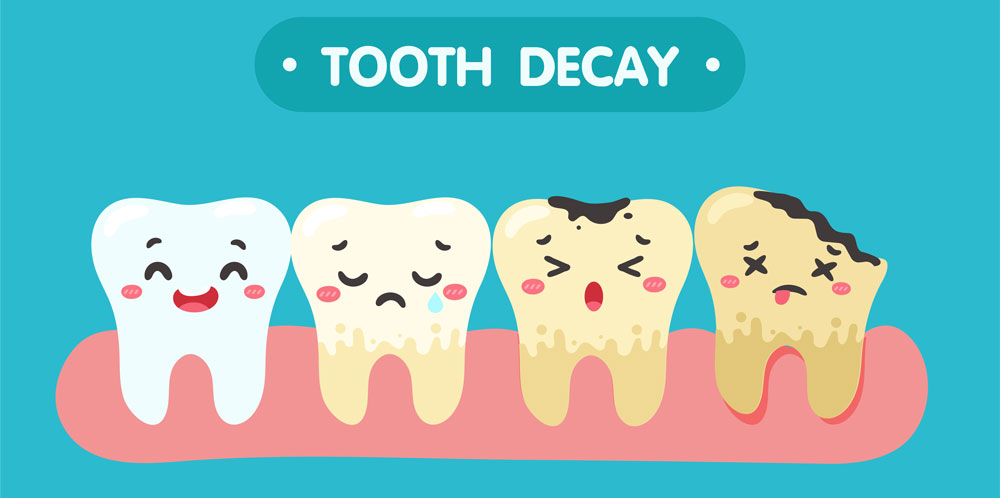 Top Causes Of Tooth Decay