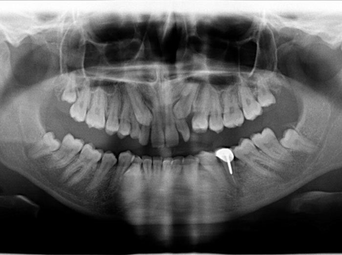 Impacted Canine ​Exposure & Treatment