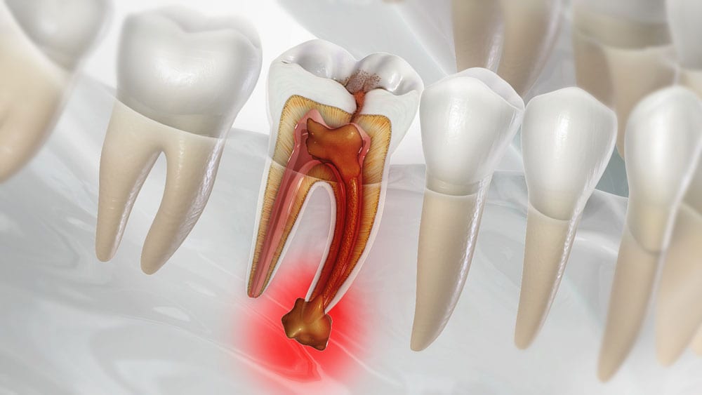 Symptoms of dental