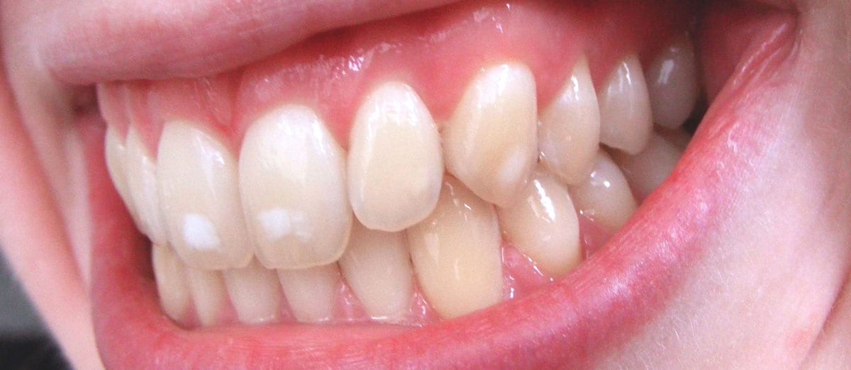 Dental Fluorosis