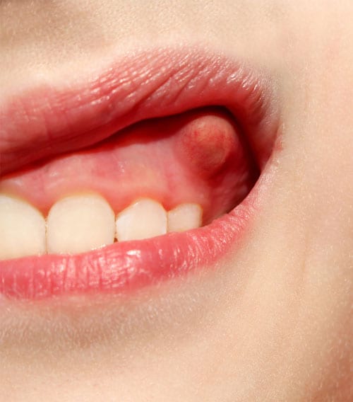 dental abscess