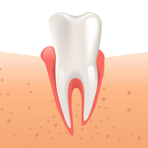 Gingivitis