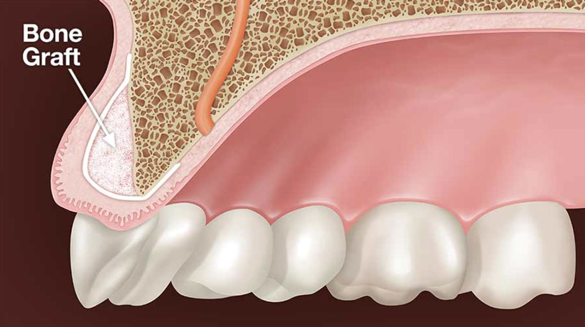 Implant to Reconstruct Jaw Bone