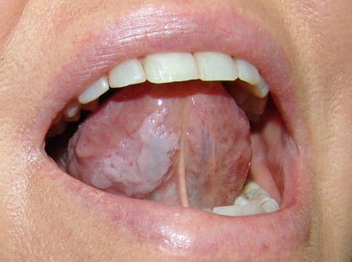 Leukoplakia: Causes, Symptoms, Treatment