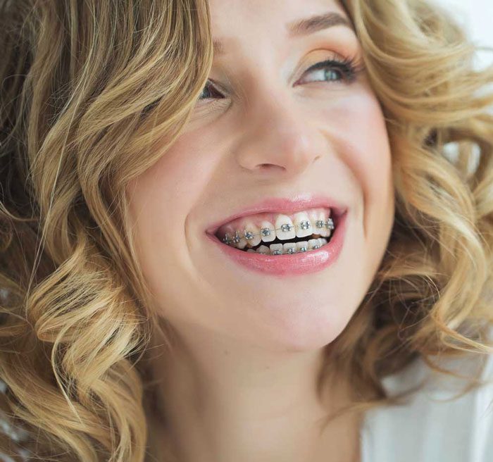 Braces