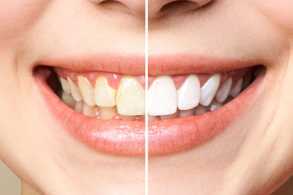 Yellow Teeth