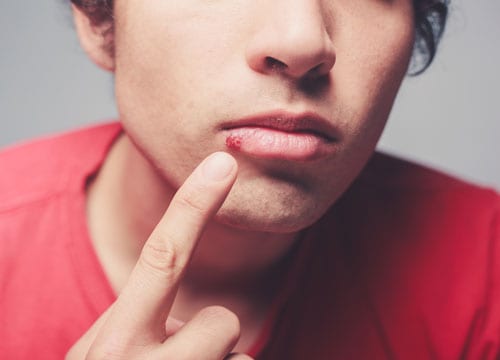Herpes Oral