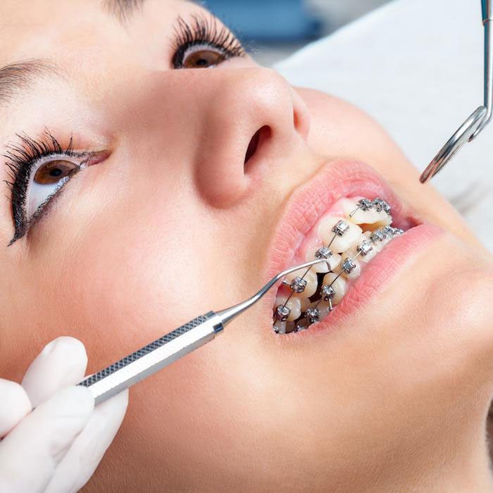 Braces