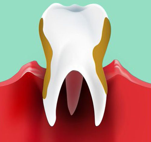 Periodontitis