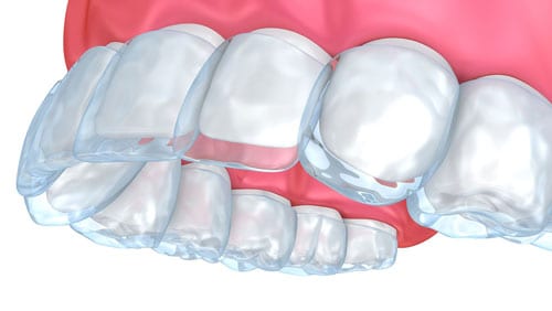 What Is An Overbite