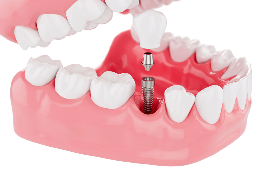 What is a dental implant