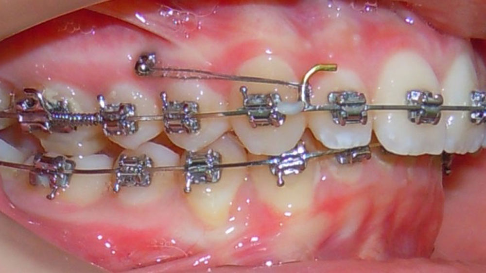 Intraoral Devices