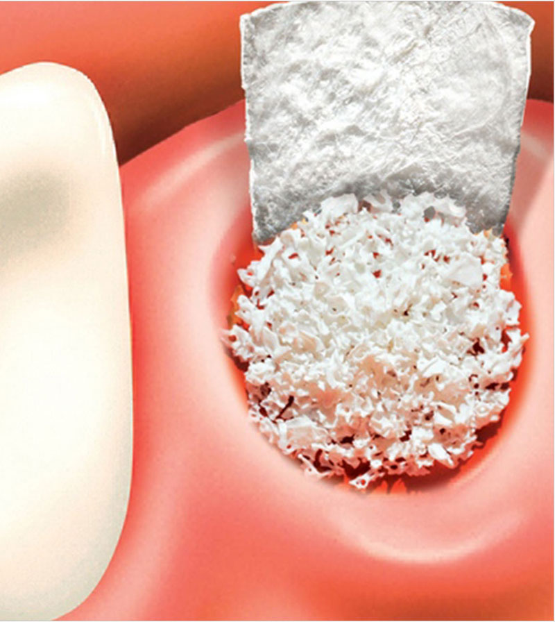 Bone Grafting