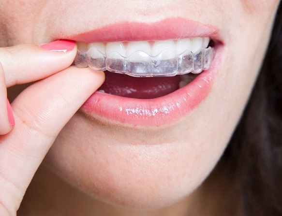 Invisalign technique