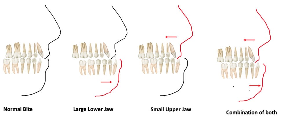 underbite