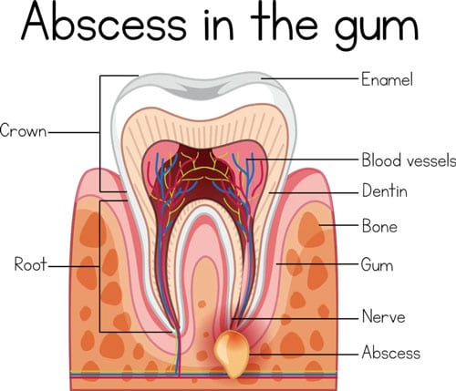 Dental Abscess