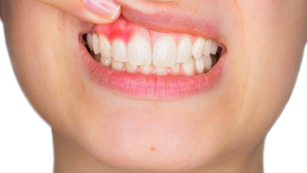 dental abscess
