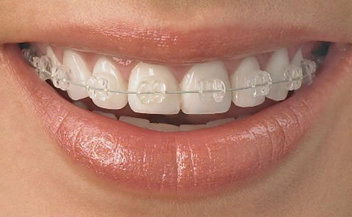 How Do Braces in Orthodontics Work?