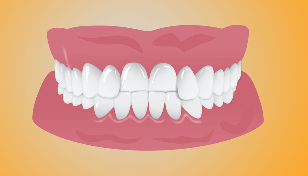 teeth are overlapping