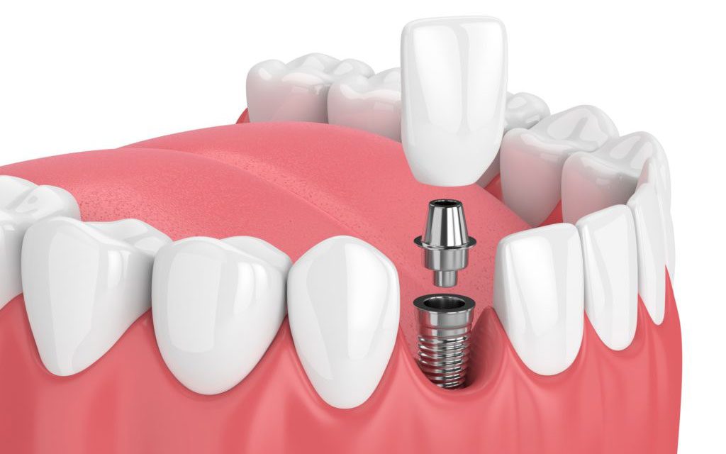 Before Getting a Dental Implant