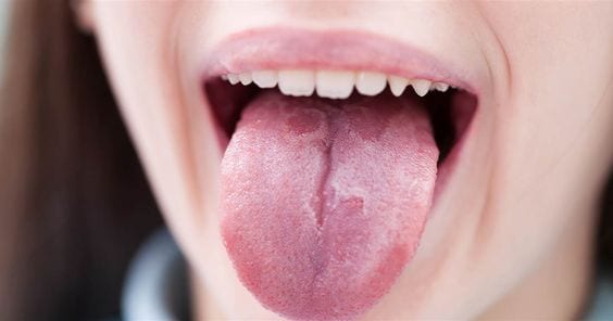 Dry Mouth