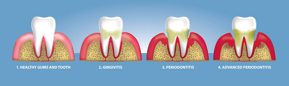 Gingivitis