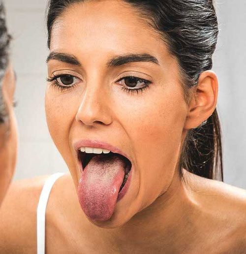 Oral lichen planus