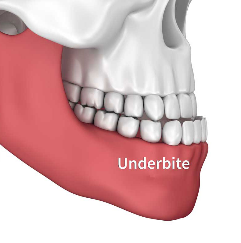 Underbite