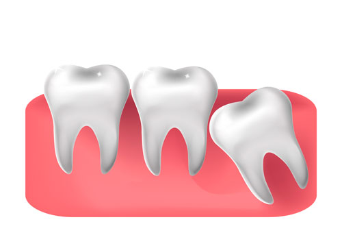 What is Wisdom Tooth