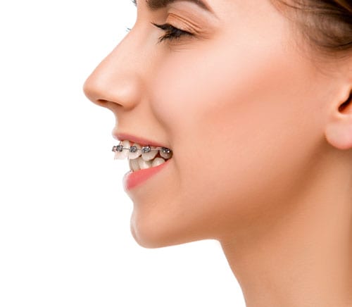 What Is An Overbite