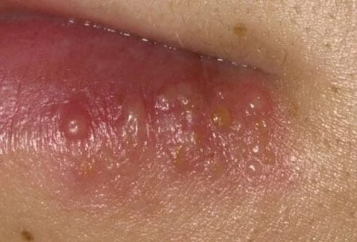Herpes Oral