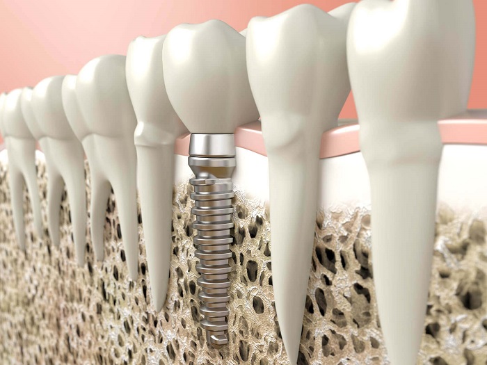 Bone Grafting