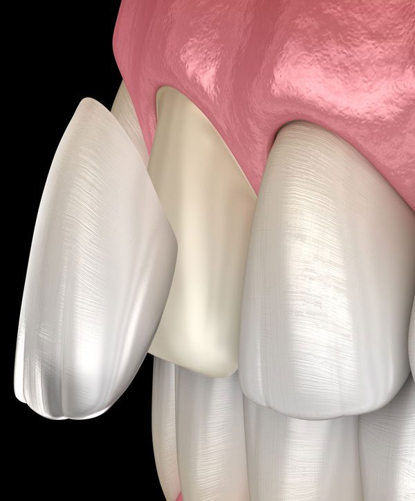 How Do Veneers Work?