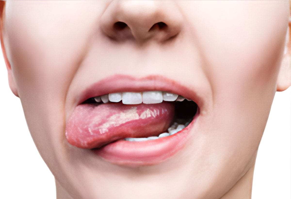 Leukoplakia