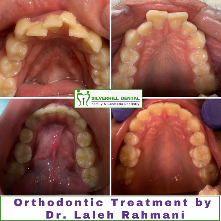 underbite