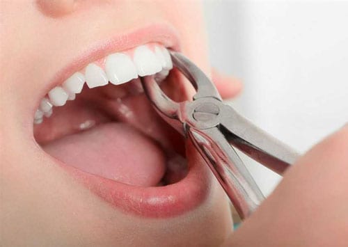 Tooth Extraction
