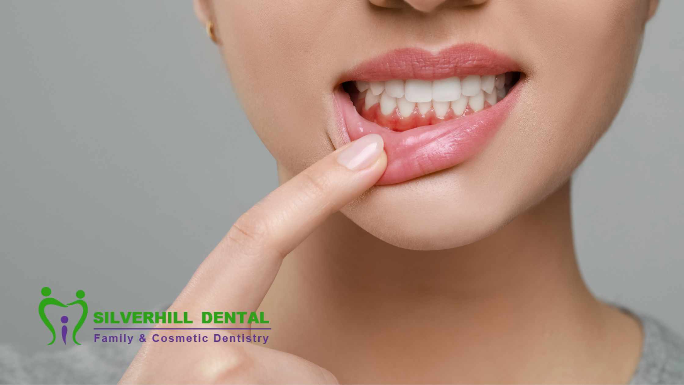 Managing Gum Sensitivity After Dental Whitening