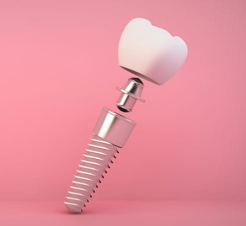 Implant Diet