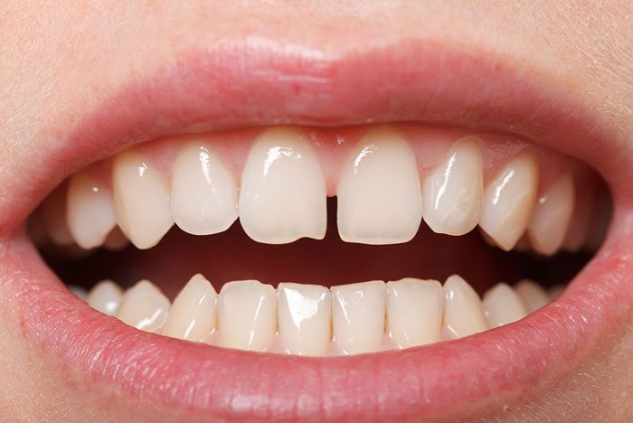 Space in Teeth