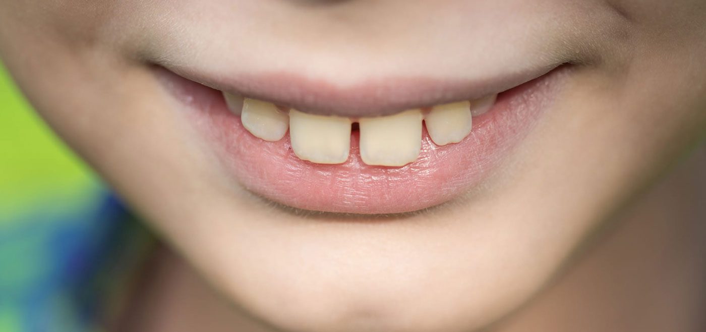 Best Ways to Fix Spacing in Teeth