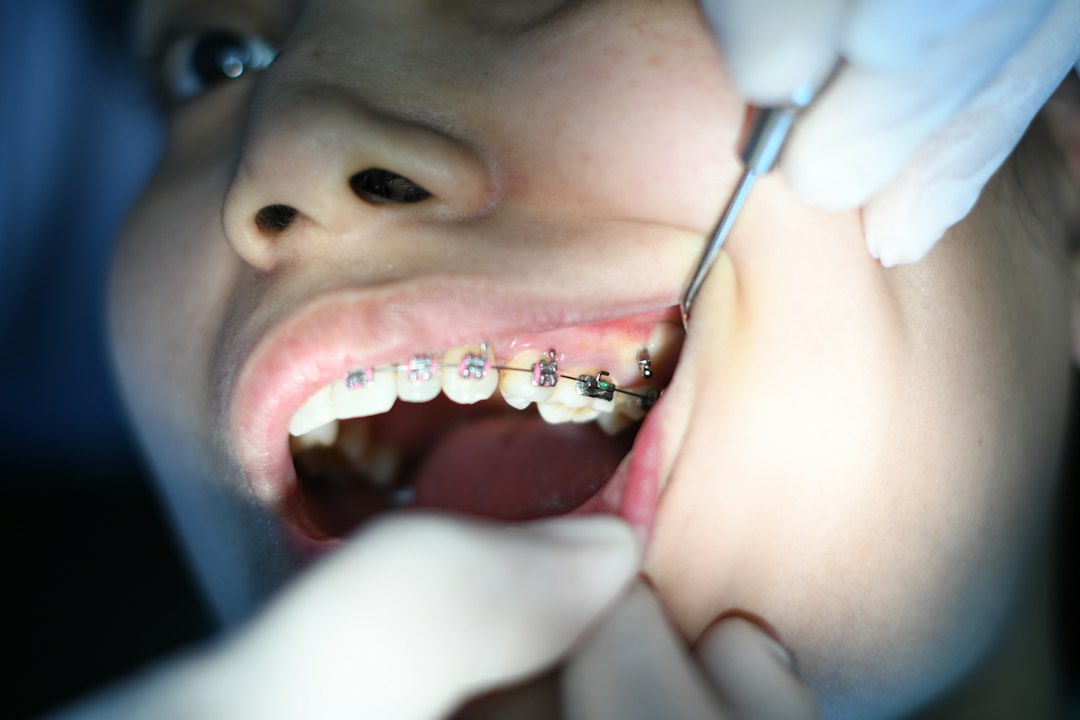Should You Keep or Extract Your Wisdom Teeth? Understanding the Signs and Weighing the Options