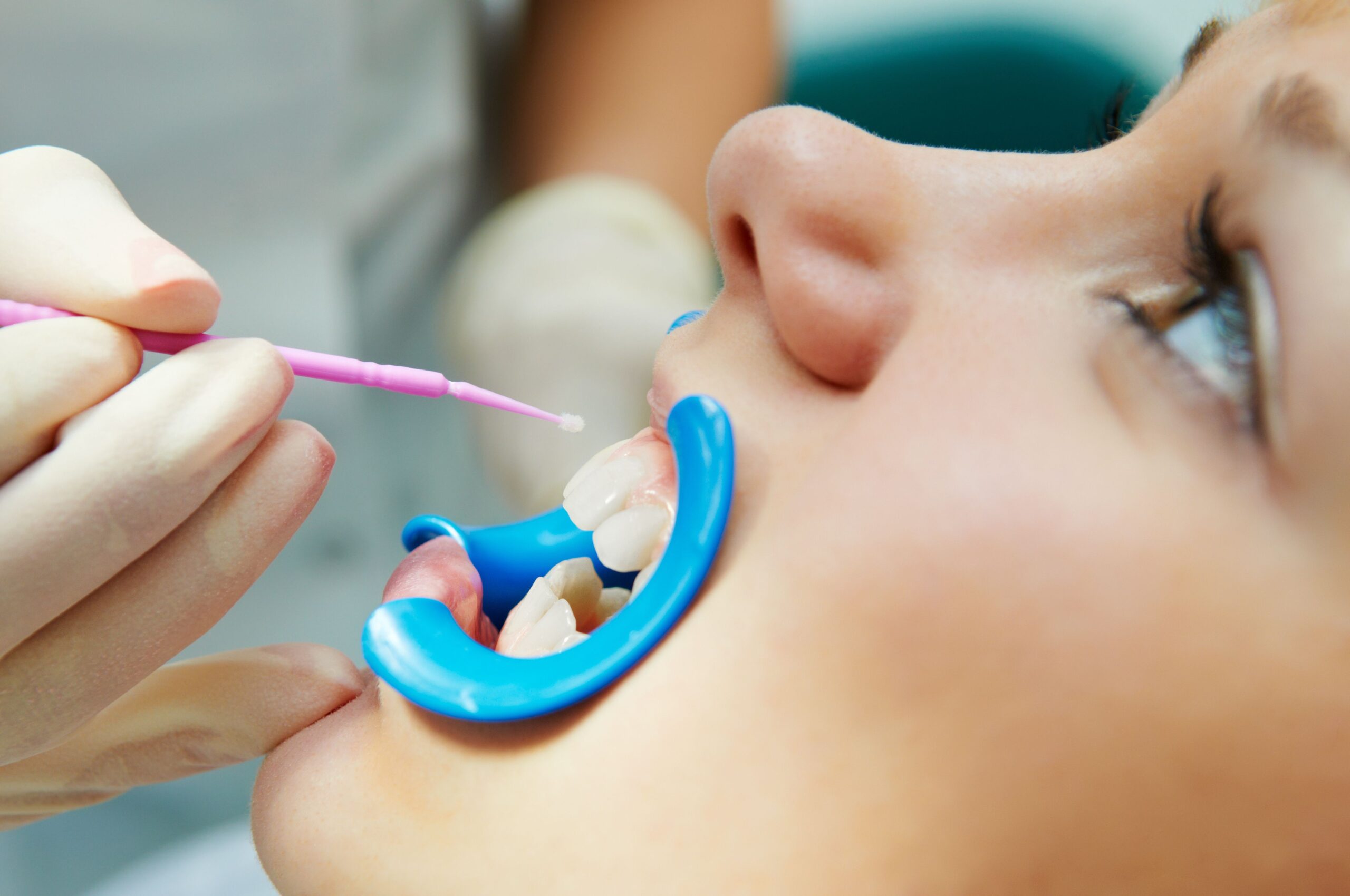 11 Benefits of Sealants and Fluoride Treatment